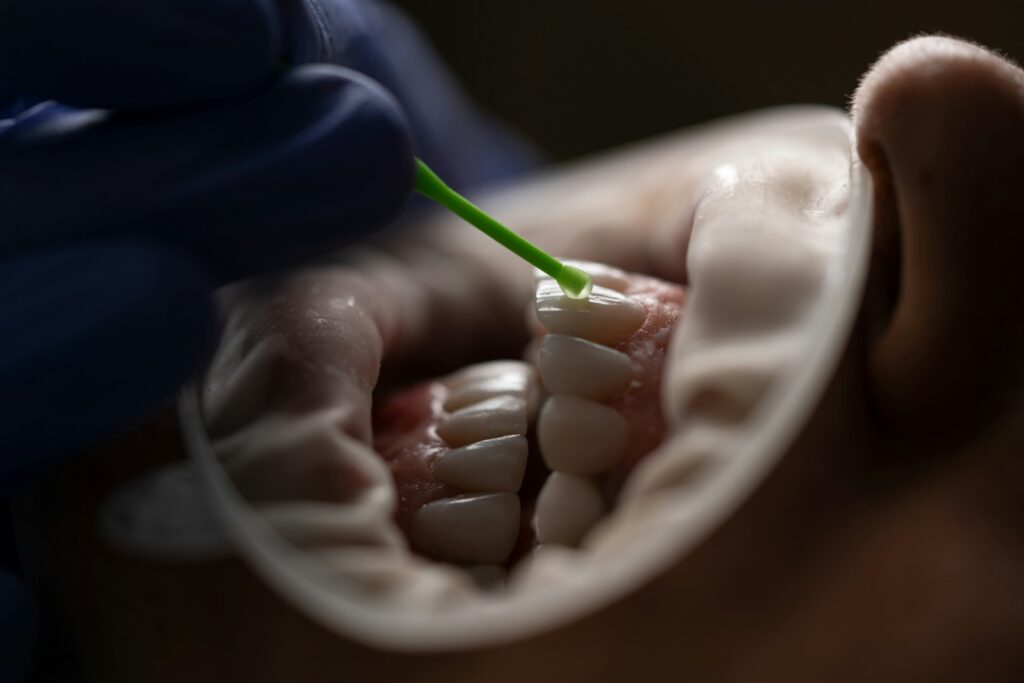 Les gouttières dentaires : une solution esthétique pour un sourire parfait