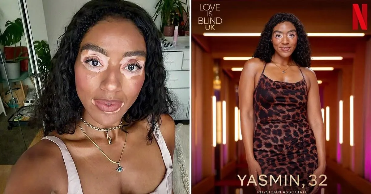 La représentation du vitiligo de Yasmin dans Love is Blind pourrait changer des vies
